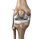 ACL Reconstruction