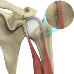 Bicep Tendon Rupture at Shoulder