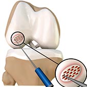 Cartilage Microfracture