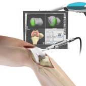 Computer Navigation for Total Knee Replacement