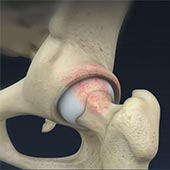 Femoral Osteoplasty