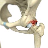 Femoroacetabular Impingement