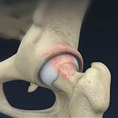 Femoroacetabular Osteoplasty