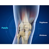 Fractures of the Patella