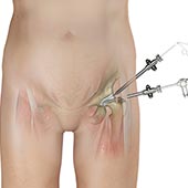 Hip Arthroscopy