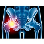 Hip Injury