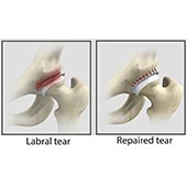 Hip Labral Repair