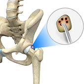 Hip Microfracture