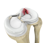 Meniscal Tears