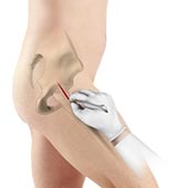 Minimally Invasive Total Hip Replacement