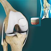 Osteochondral Defect of the Knee