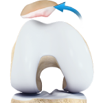 Patellar Instability