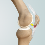 Patellar Tendinitis