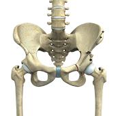 Periacetabular Osteotomy