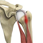 Proximal Biceps Tendinitis