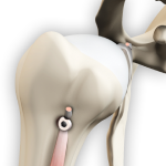 Proximal Biceps Tenodesis