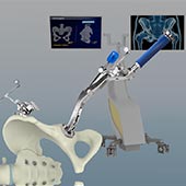 Robotic Total Hip Replacement