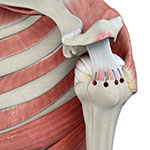 Rotator Cuff Repair