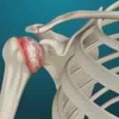 Arthritis of the Shoulder