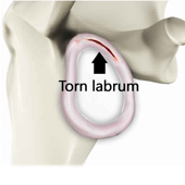 Shoulder Labral Tear