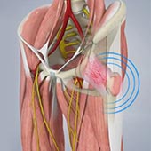 Snapping Hip Syndrome