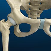 Stress Fractures of the Hip