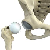 Surgical Dislocation of the Hip