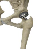 Total Hip Replacement