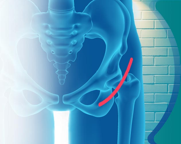 Anterior Hip Replacement